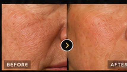Before and after: skin texture treatment